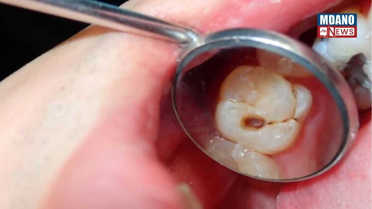 Dental Care News In Hindi: हमारी मुस्कान हमारी व्यक्तित्व का आईना होती है, लेकिन आज की भागदौड़ भरी जिंदगी और गलत खान-पान के कारण दांतों की समस्याएं आम हो गई हैं।